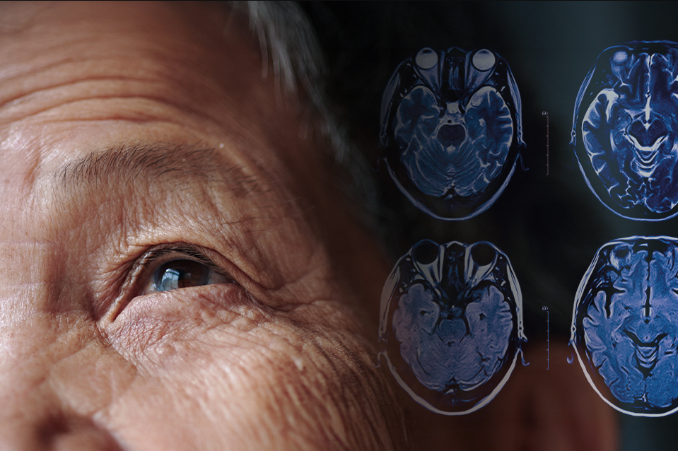 Parkinson Hastalığı